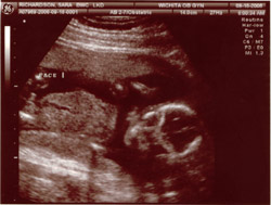 Sonogram Face