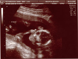 Sonogram Face Sonogram Face