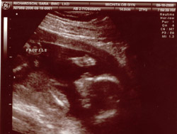 Sonogram Profile