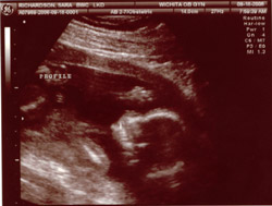 Sonogram Profile Sonogram Profile