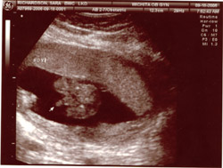 Sonogram Other Sonogram Other